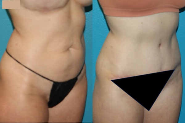 Abdominoplasty