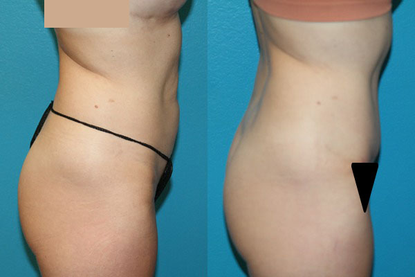 Abdominoplasty