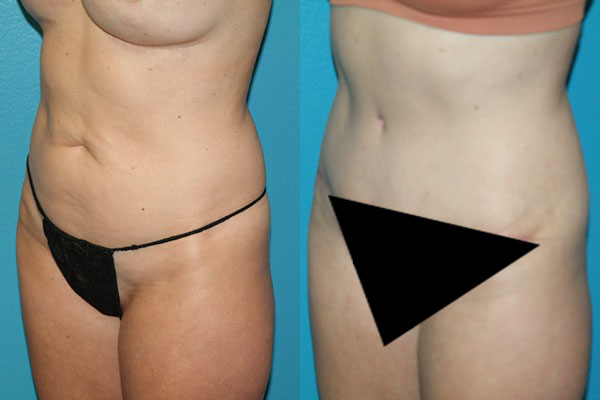 Abdominoplasty