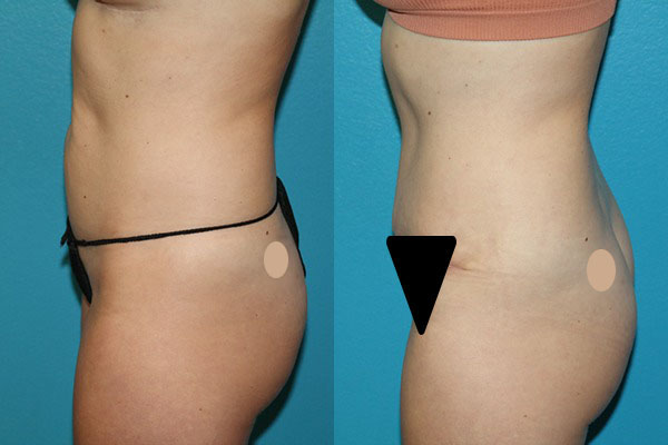 Abdominoplasty