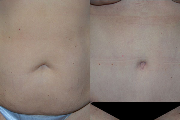 Abdominoplasty