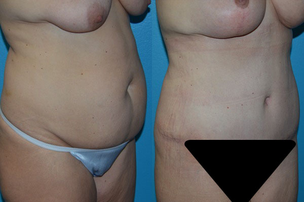 Abdominoplasty