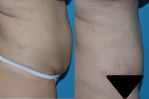 Abdominoplasty