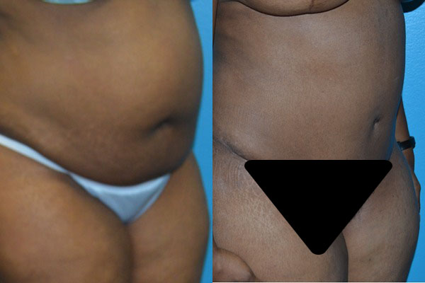 Abdominoplasty