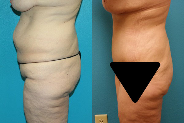 Abdominoplasty