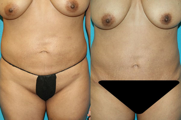Abdominoplasty