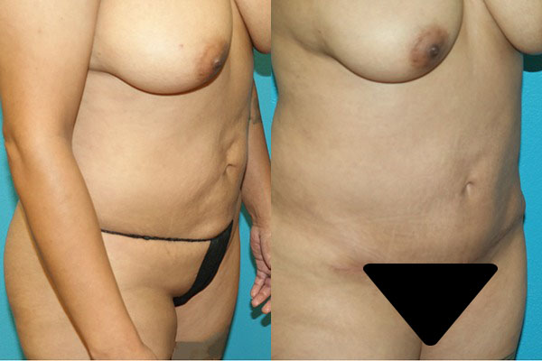 Abdominoplasty
