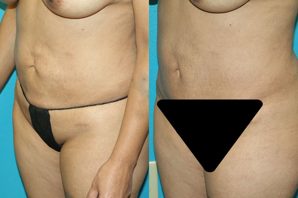 Abdominoplasty