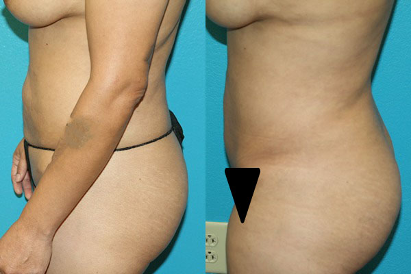 Abdominoplasty
