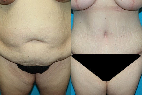 Abdominoplasty