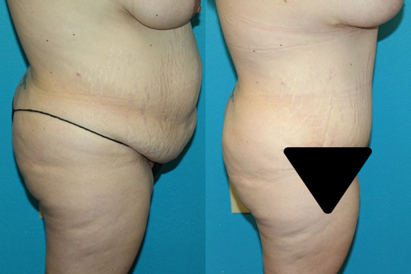 Abdominoplasty