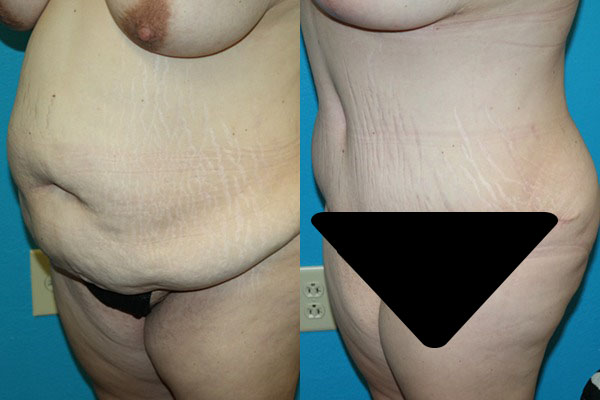 Abdominoplasty