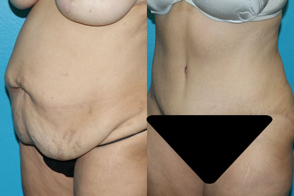 Abdominoplasty