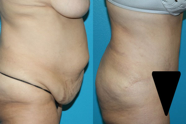 Abdominoplasty